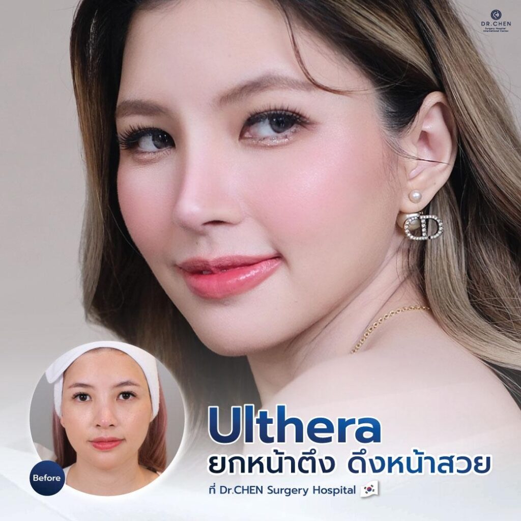 โปรแรง Ulthera ยกหน้าวี แบบสาวเกาหลี 🇰🇷