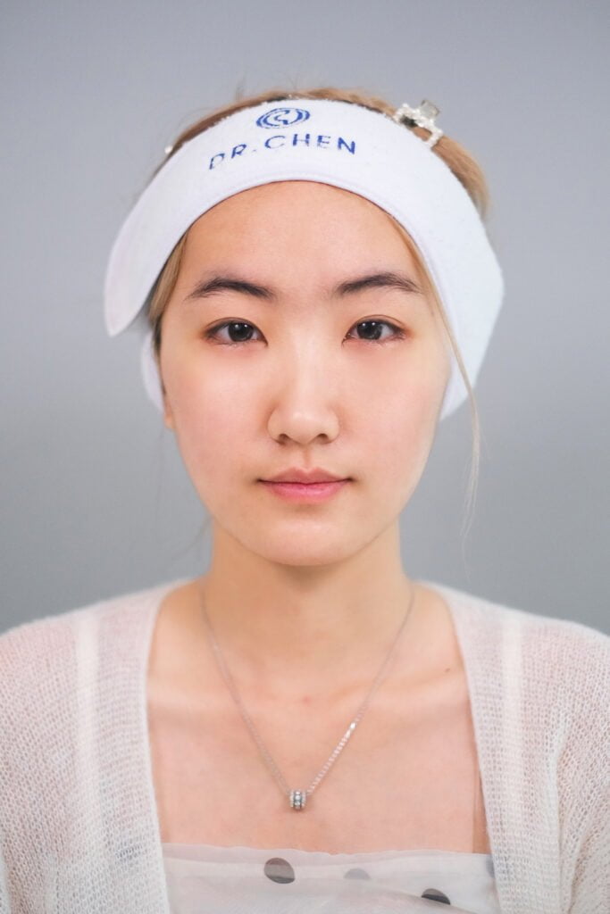 รีวิวจัดเรียงไขมันใต้ตาคุณปาร์มมี่