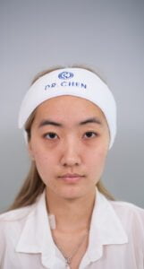 ก่อนจัดเรียงไขมันใต้ตา 1