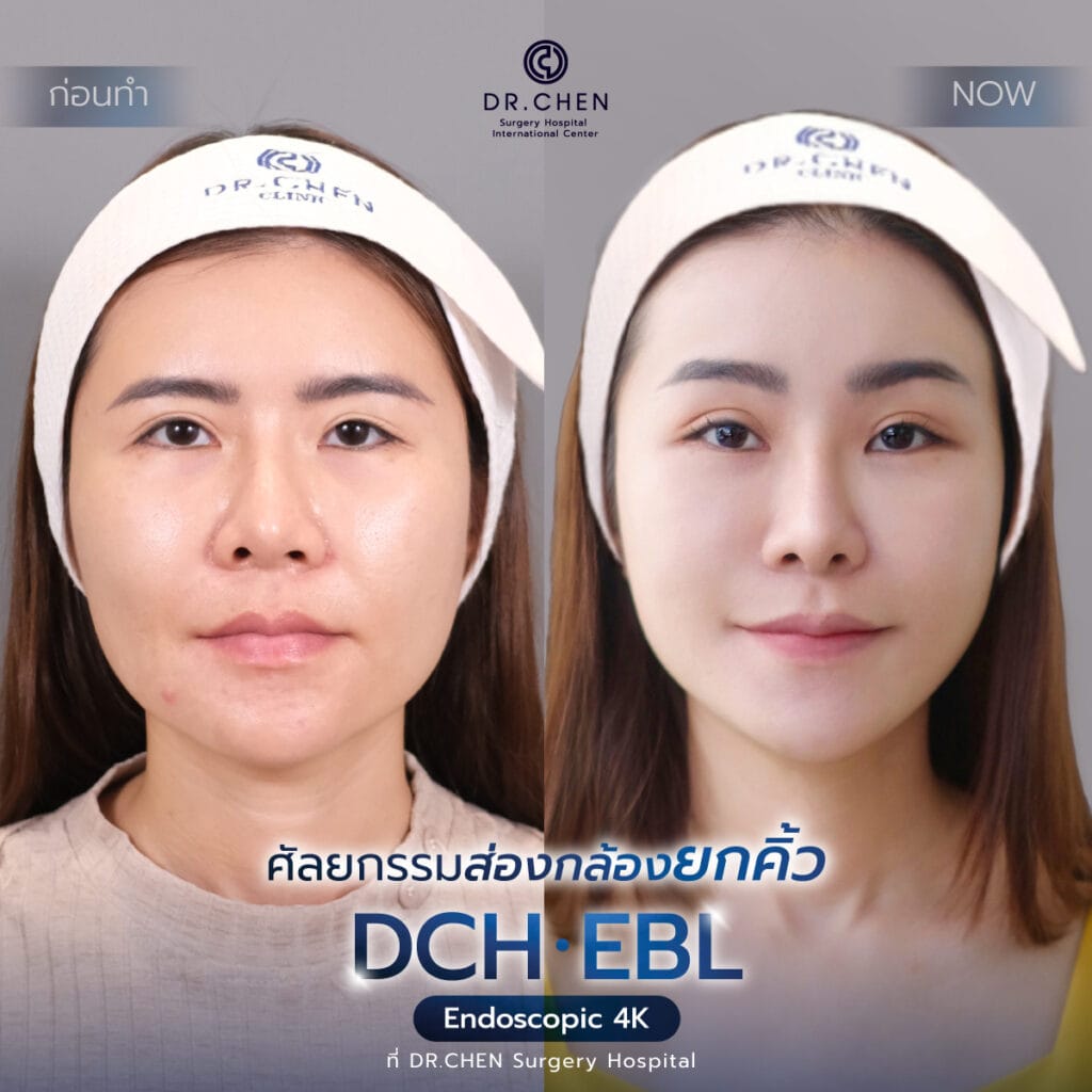 DCH EBL นวัตกรรมยกคิ้วที่ใครๆ ก็บอกต่อ - DCH Hospital