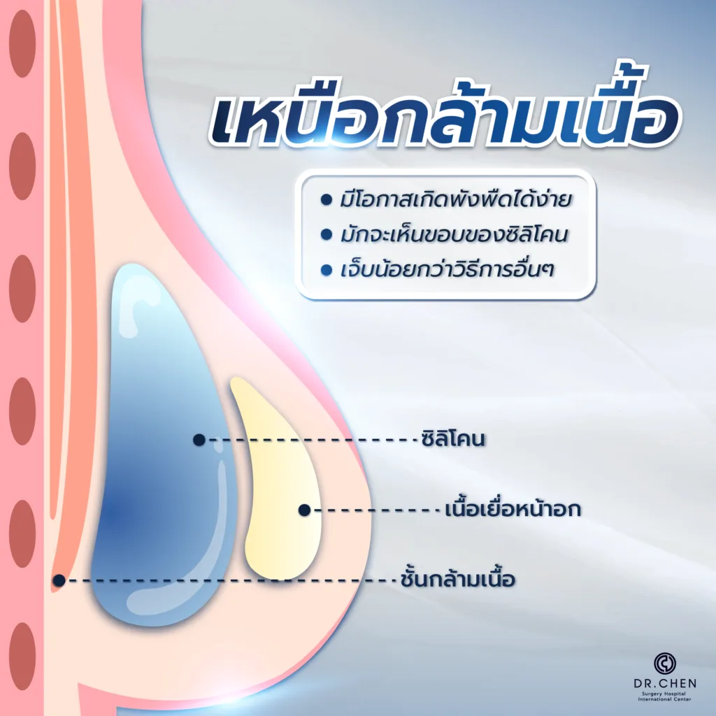 เทคนิคการเสริมหน้าอกเหนือกล้ามเนื้อ