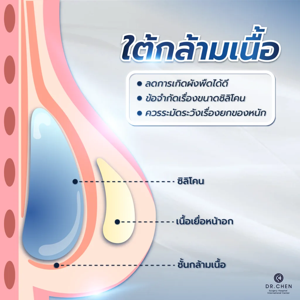 เสริมหน้าอกวางซิลิโคนใต้กล้ามเนื้อ