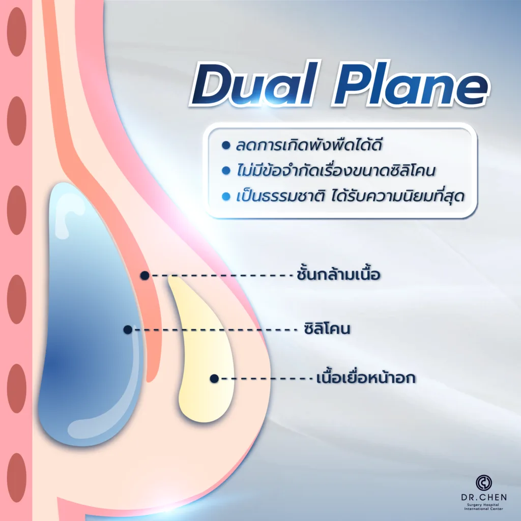 เสริมหน้าอกวางซิลิโคน เทคนิค Dual Plane