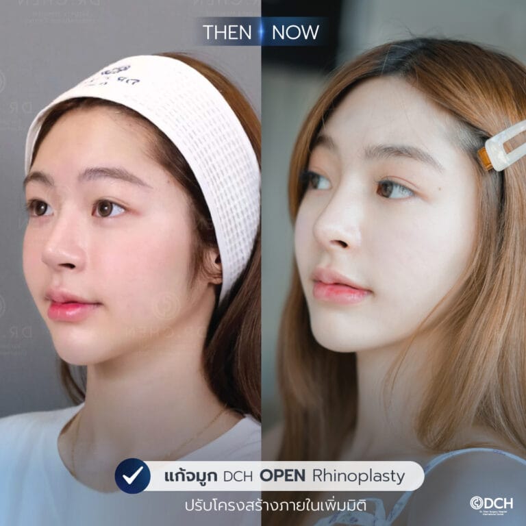 รีวิวจมูกคุณเบล
