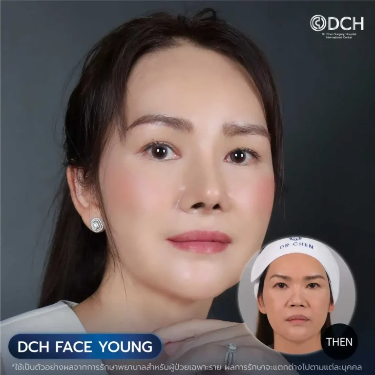 ศัลยกรรมดึงหน้า