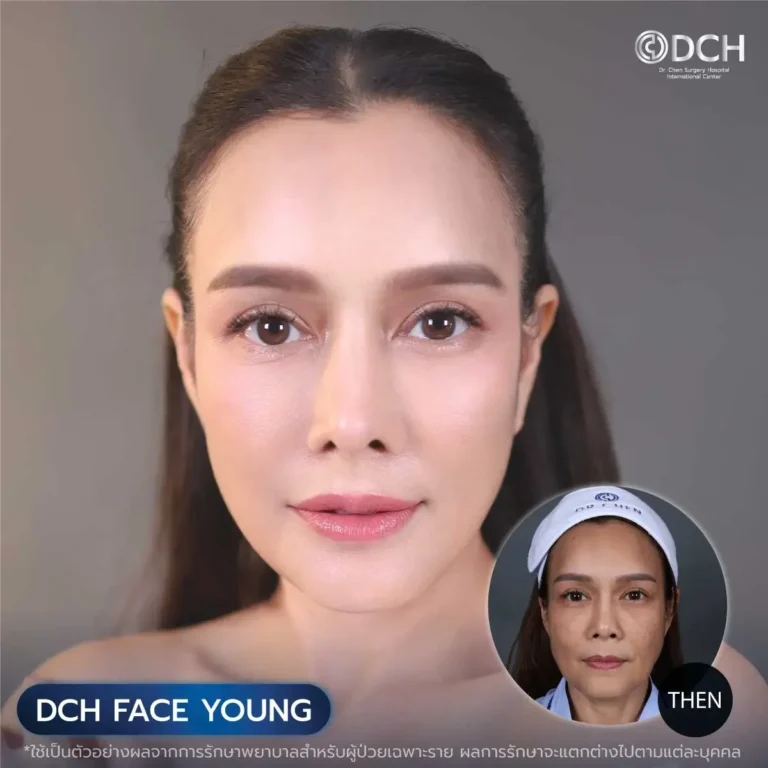 ศัลยกรรมดึงหน้า