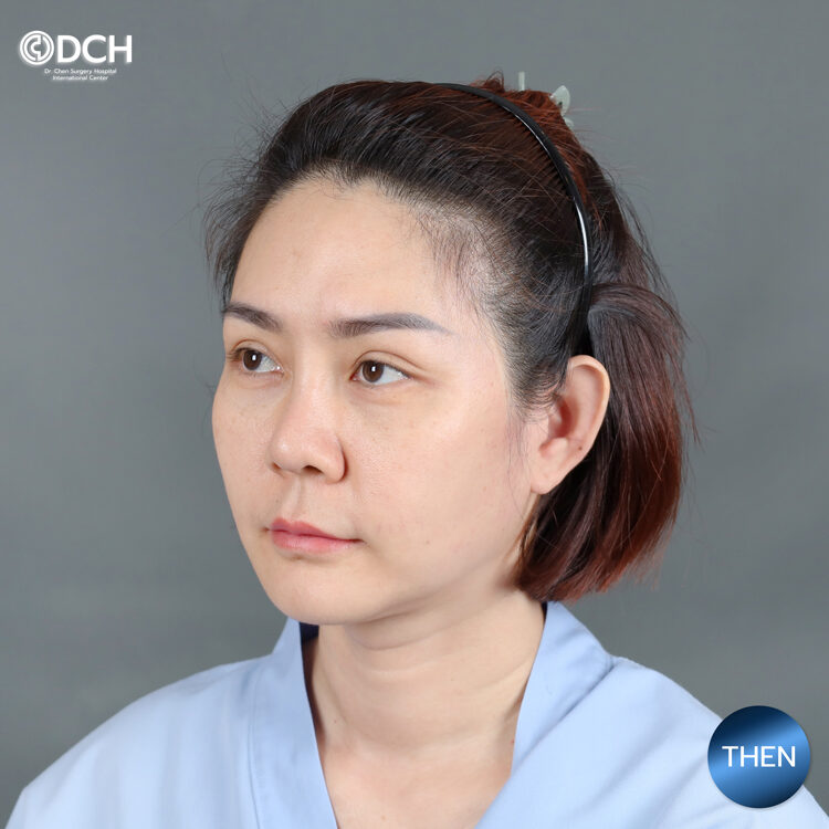 แก้จมูก