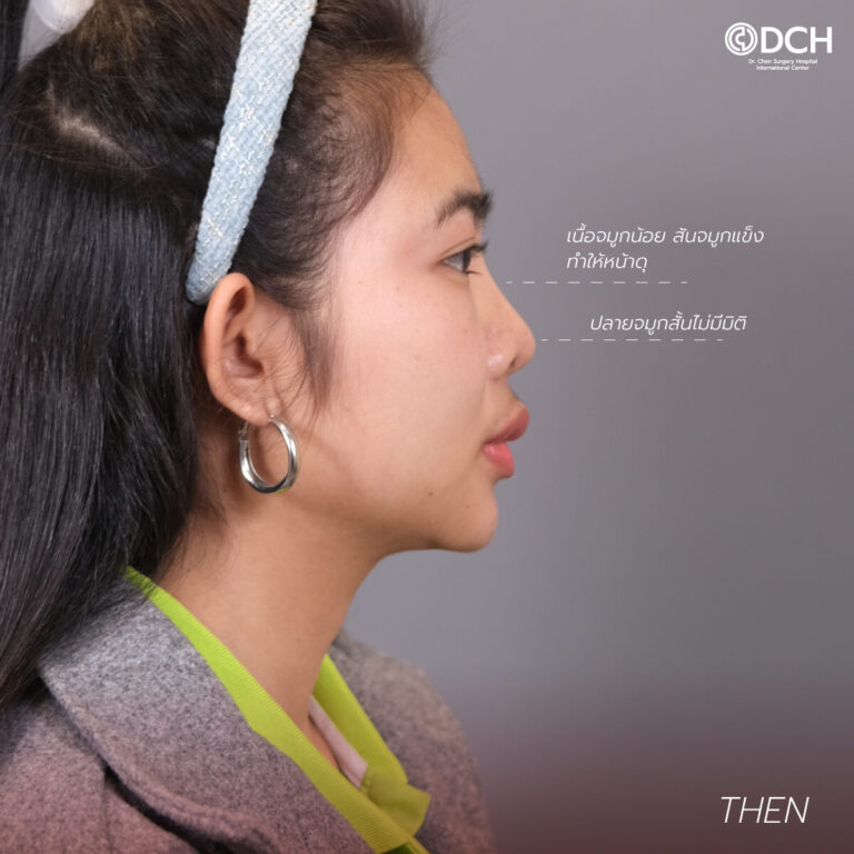 คุณนุกกี้แก้จมูก+เสริมหน้าอกก่อนทำ