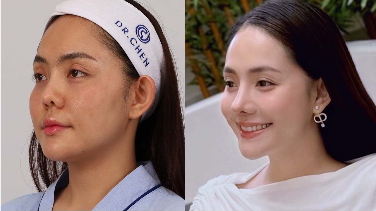 แก้จมูกที่ไหนดีคุณไวน์