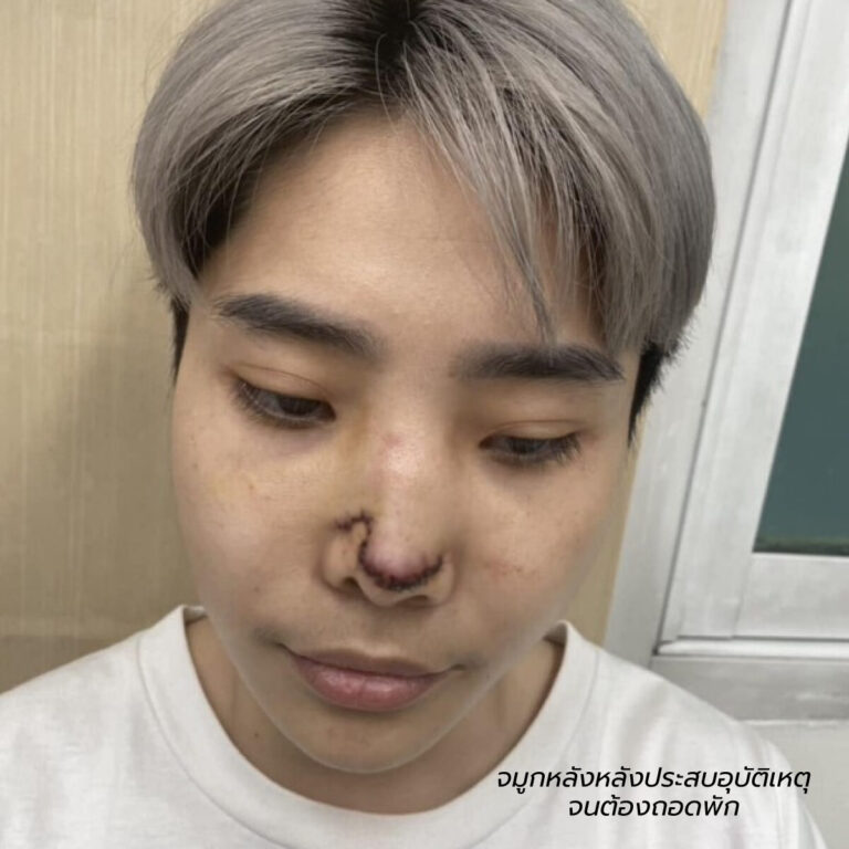 แก้จมูกคุณผึ้้งก่อนทำ1