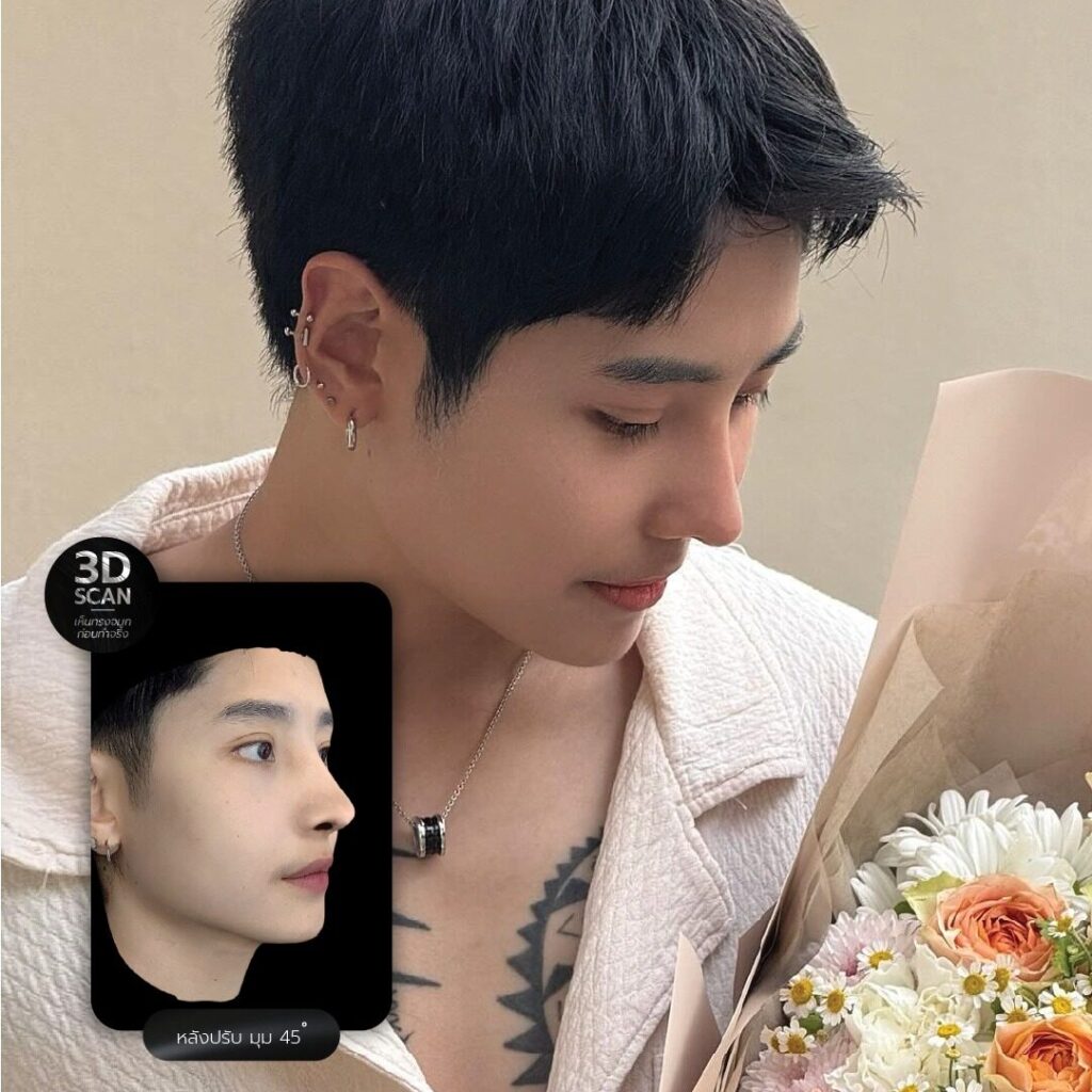 แก้จมูกคุณผึ้งสแกน3มิติ
