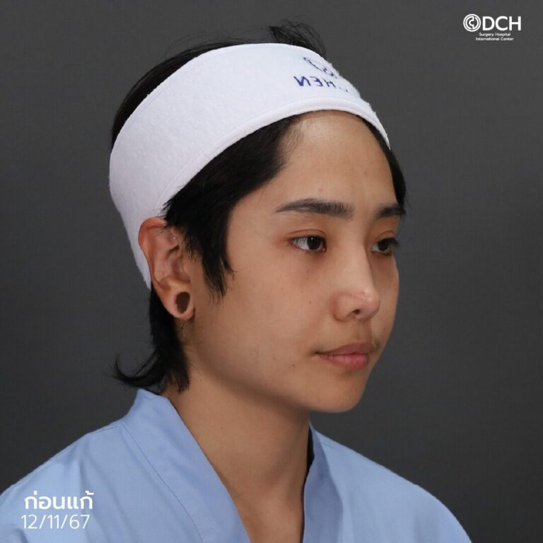 แก้จมูกคุณผึ้้งก่อนทำ2