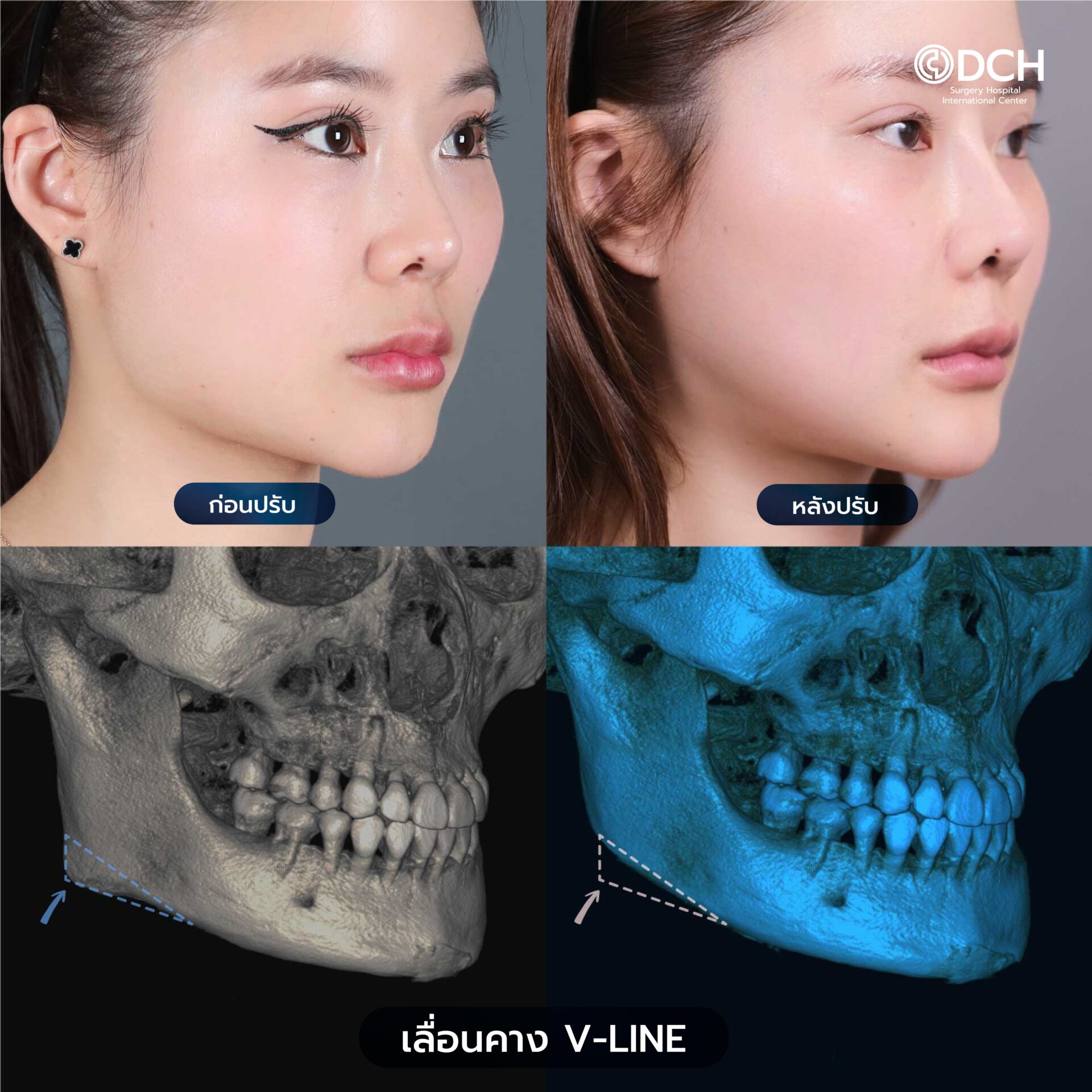 ปรับโครงหน้า