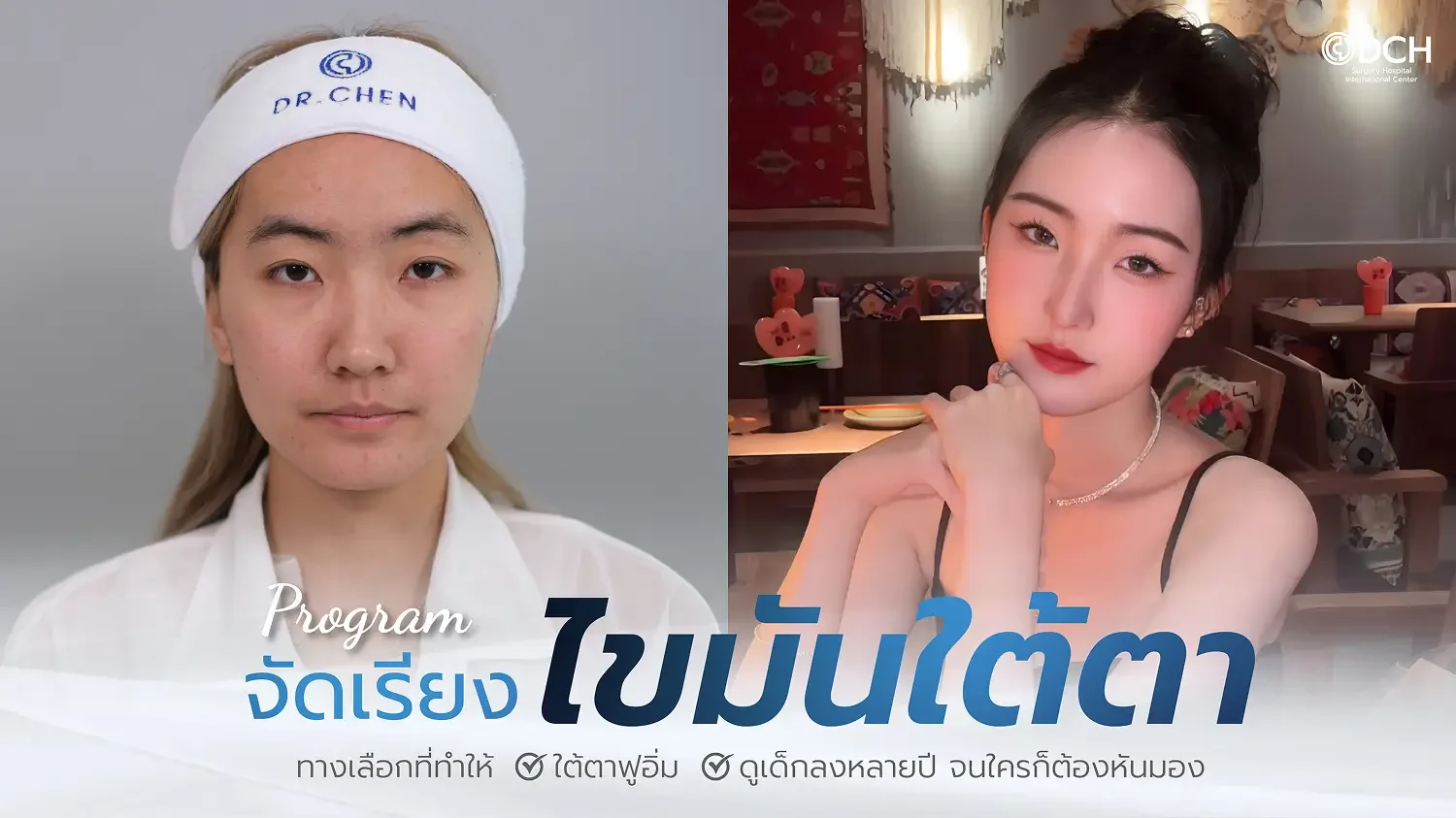 จัดเรียงไขมันใต้ตา