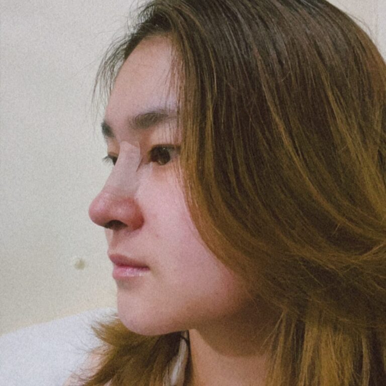 คุณแอน หลังเสริมจมูก2