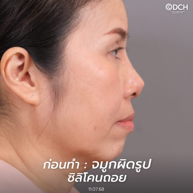 ก่อนแก้จมูกคุณอ้อย