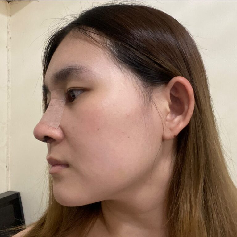 คุณแอน หลังเสริมจมูก1