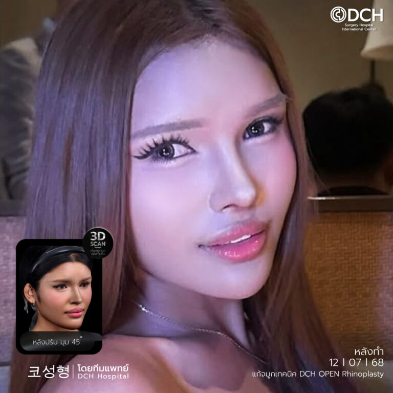 คุณเซอร์เวย์-หลังแก้จมูก1