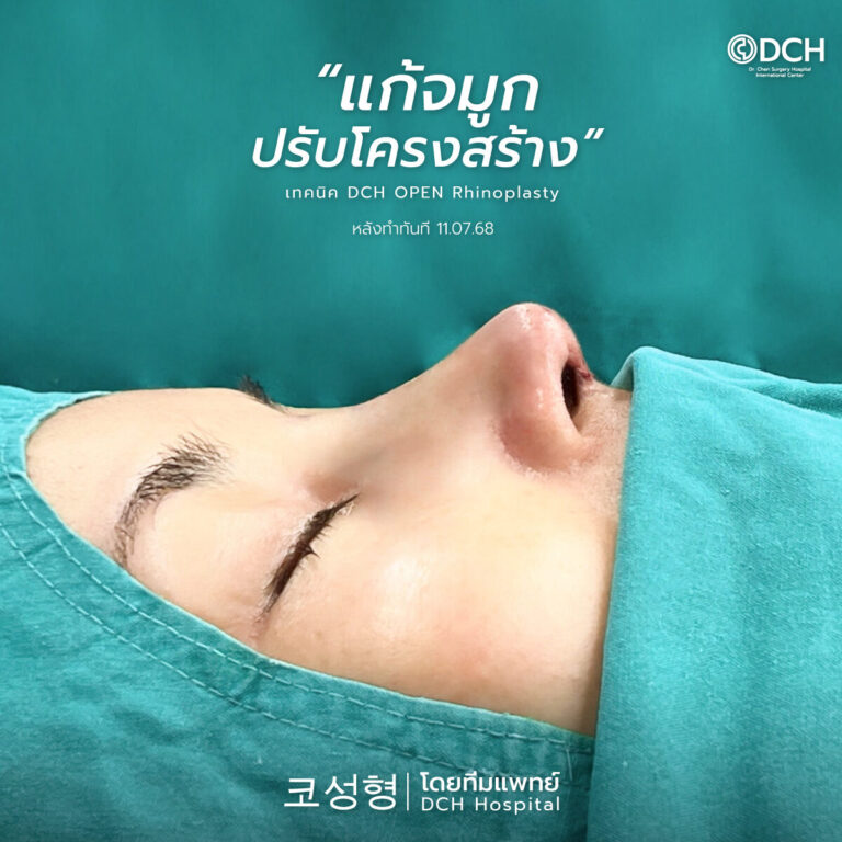 หลังแก้จมูกคุณอ้อย-1