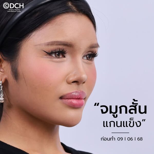 คุณเซอร์เวย์-ก่อนแก้จมูก