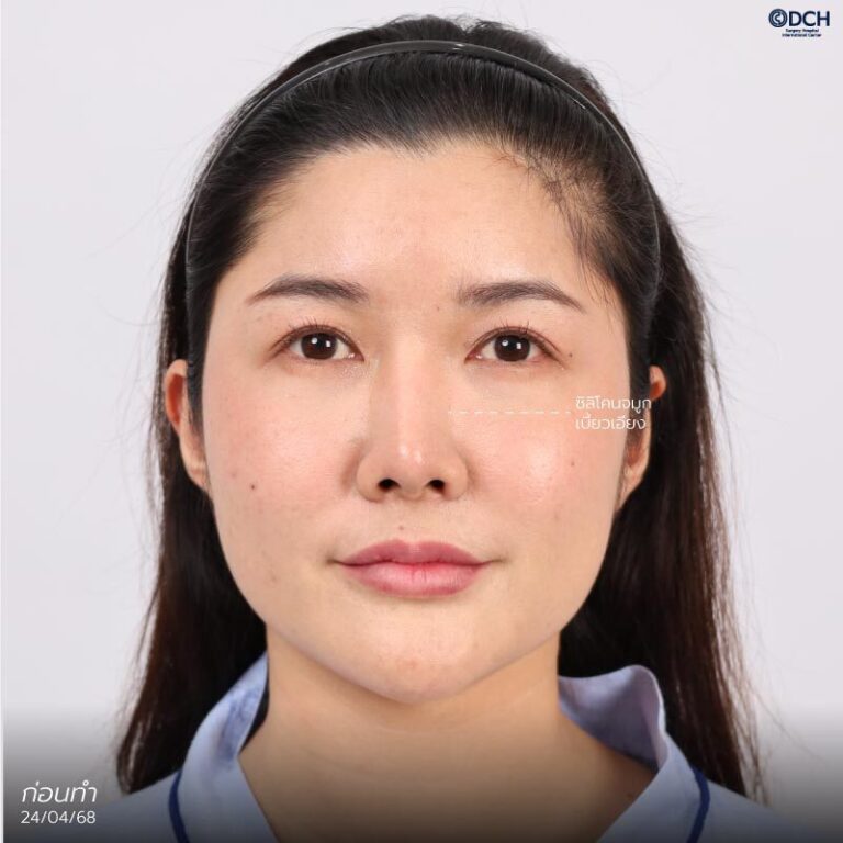 คุณฟ้า-แก้จมูกซี่โครง-ก่อนแก้1