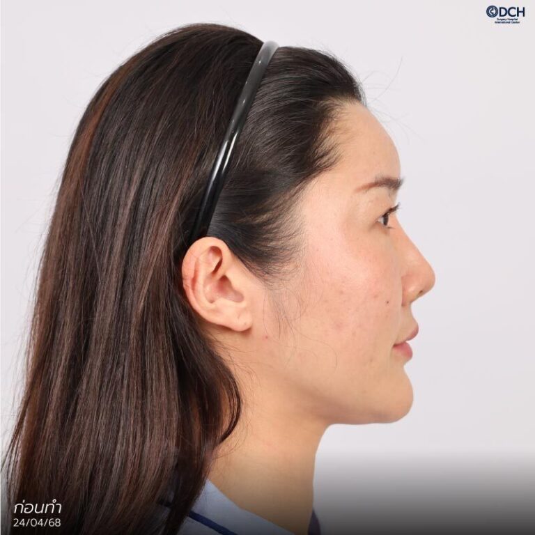 คุณฟ้า-แก้จมูกซี่โครง-ก่อนแก้2