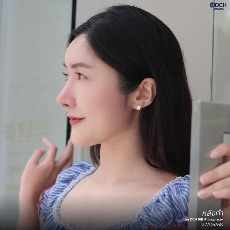 คุณฟ้า-แก้จมูกซี่โครง-หลังแก้2