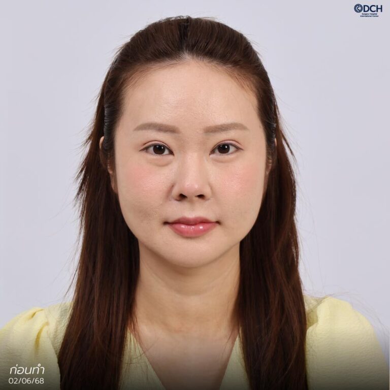 คุณลีออน-ก่อนแก้จมูก