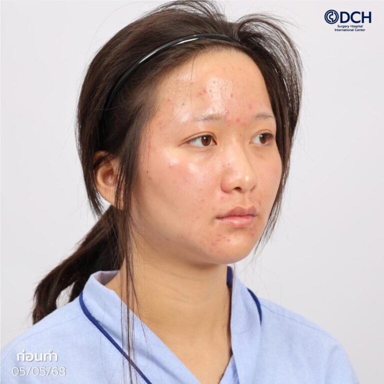 คุณใบเตยเสริมจมูกโอเพ่น-ก่อนทำ