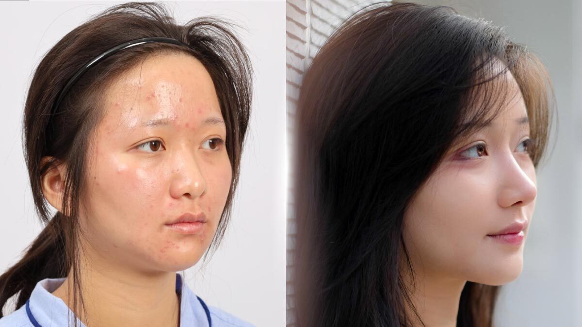 ปกบทความคุณใบเตยเสริมจมูกโอเพ่น