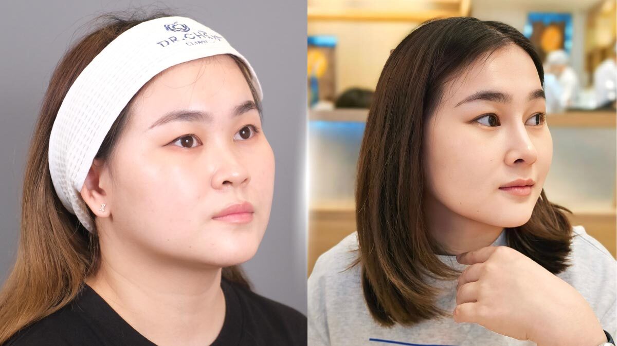 ปกบทความเสริมจมูกคุณแอน