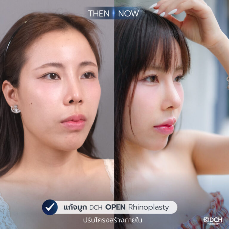 รีวิวจมูก-B-A-กิ๊ฟ