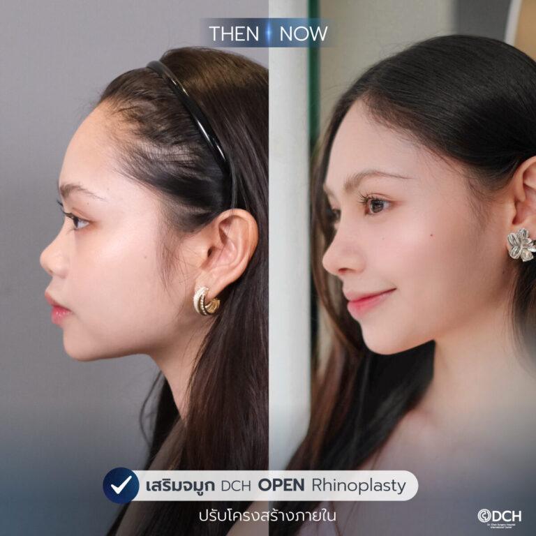 รีวิวจมูก-B-A-ขิม_0