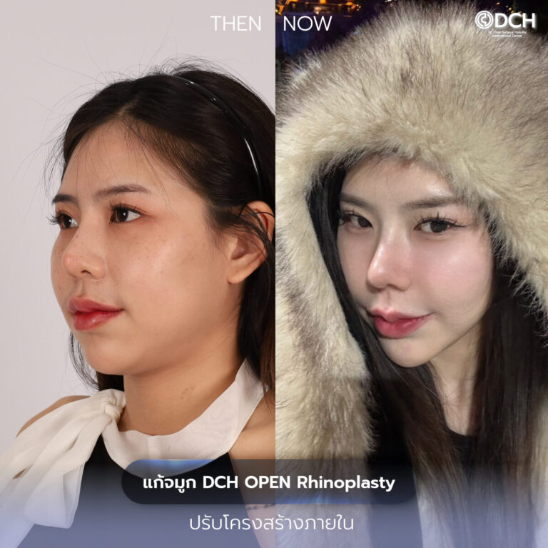รีวิวจมูก-B-A-มาย_0