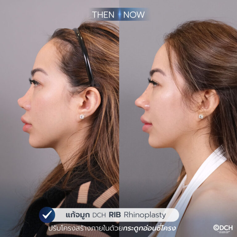 รีวิวจมูก-B-A-ยูกิ-3_0