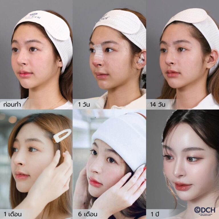 เสริมจมูกกี่วันหายบวม-คุณเบลล์