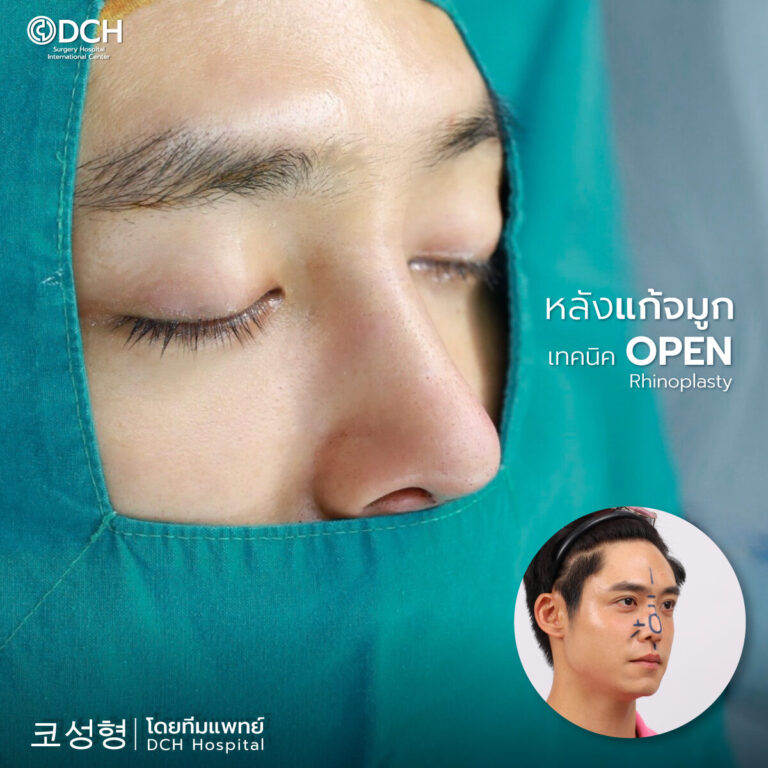 แก้จมูกโอเพ่น คุณฮิม หลังทำทันที