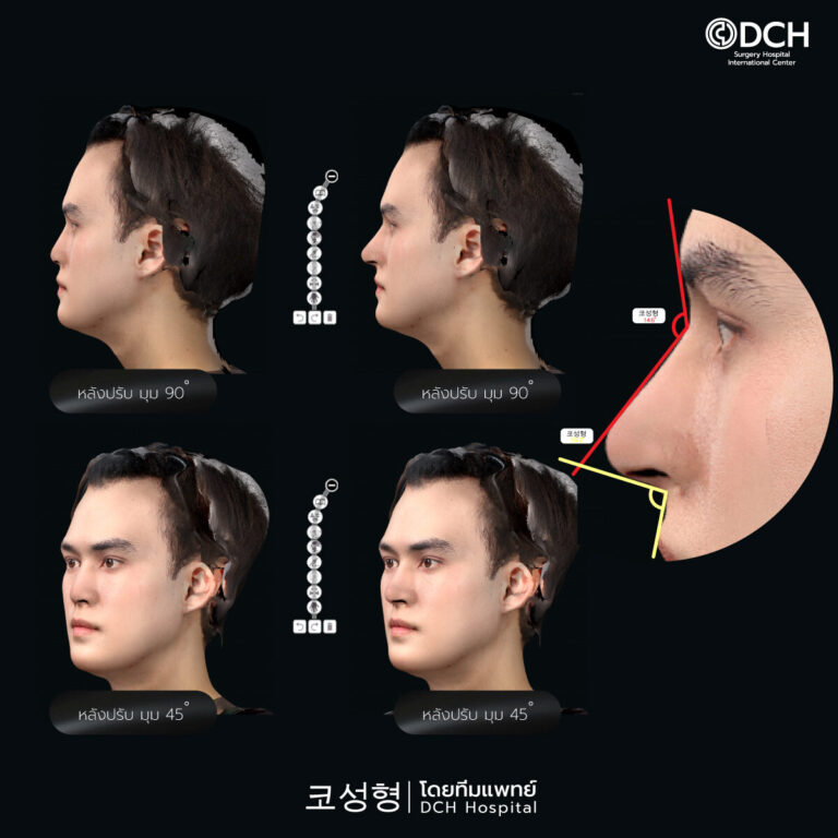 คุณกอเกียร์ แก้จมูก 3d