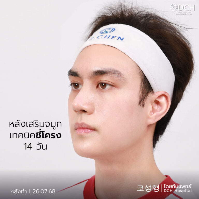 คุณกอเกียร์ แก้จมูก หลังทำ