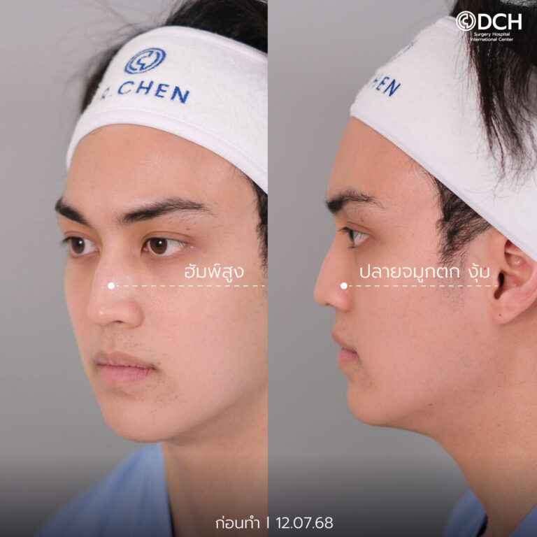 คุณกอเกียร์ ก่อนแก้จมูก