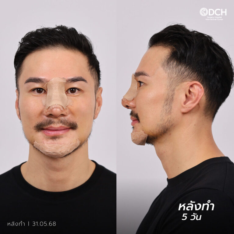 แก้จมูก+เสริมคาง คุณลีโอ หลังทำ 5 วัน