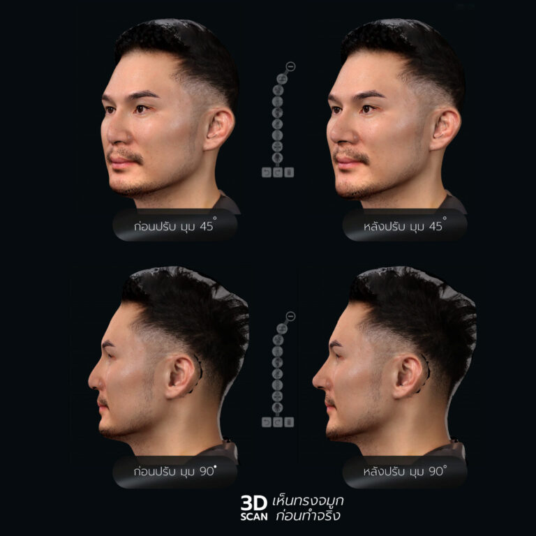 แก้จมูก+เสริมคาง 3d คุณลีโอ