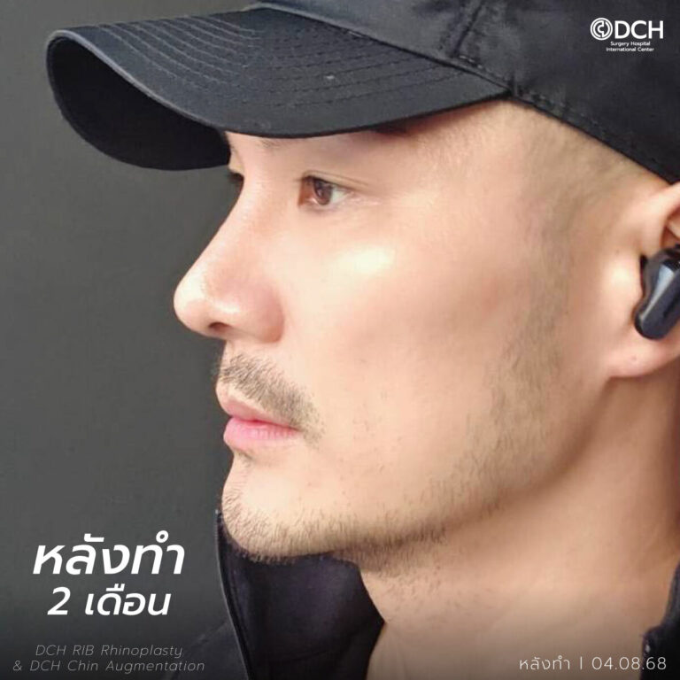 แก้จมูก+เสริมคาง คุณลีโอ หลังทำ