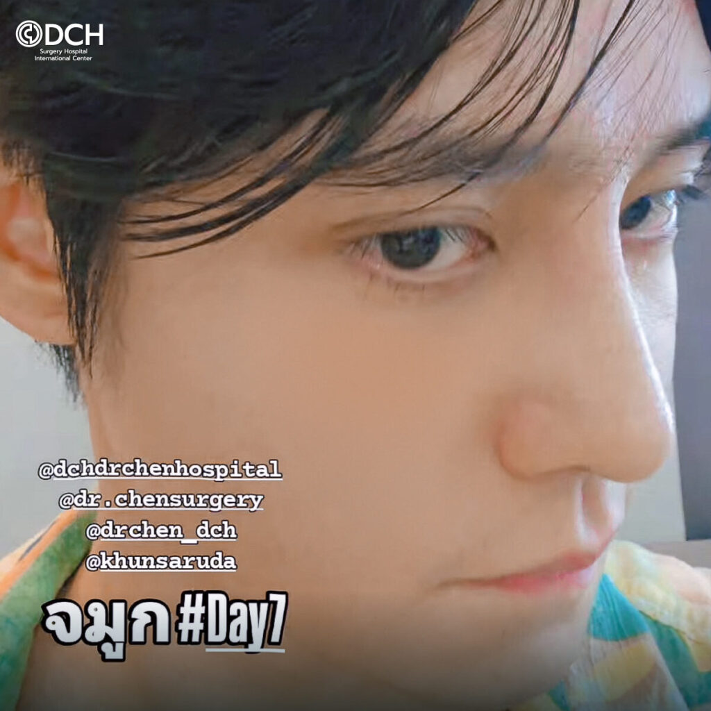 แก้จมูกโอเพ่น คุณฮิม 7 วัน