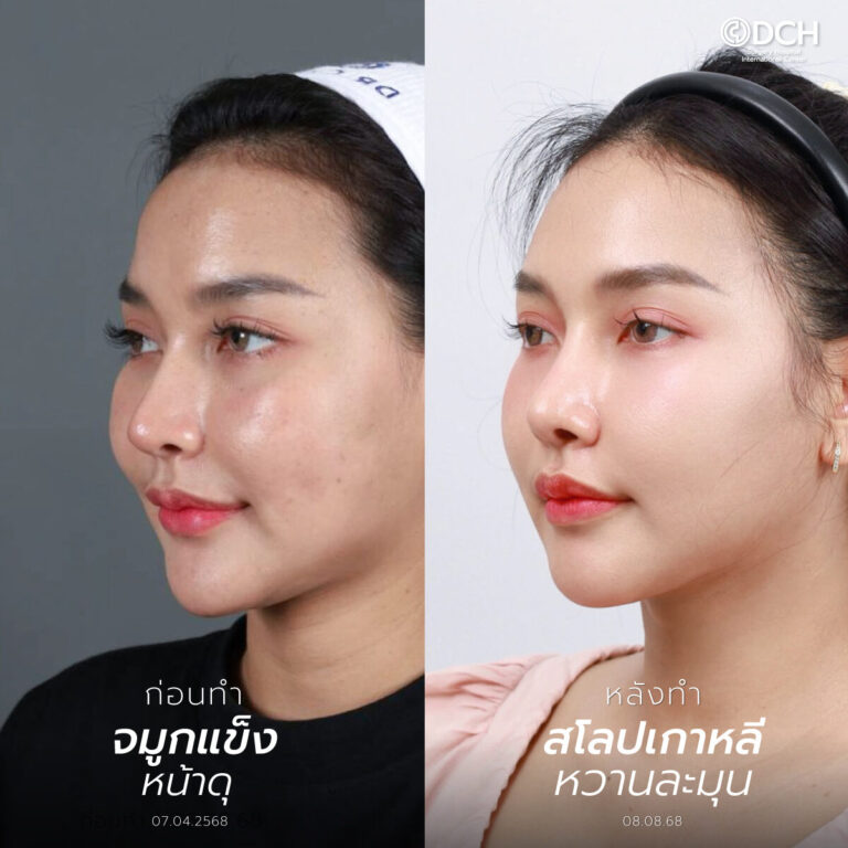 ก่อนและหลัง แก้จมูกโอเพ่น คุณกิ๊ฟ