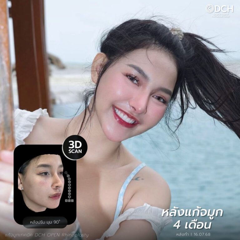 แก้จมูกโอเพ่น คุณกิ๊ฟ หลังทำ 4 เดือน