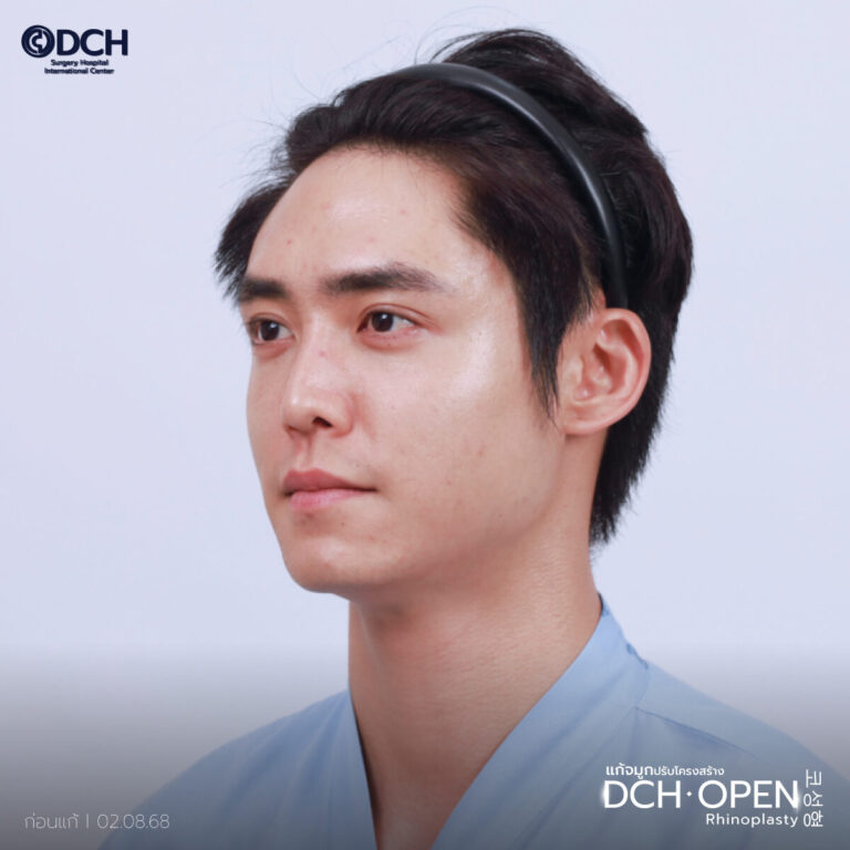 คุณฮิมก่อนแก้จมูก