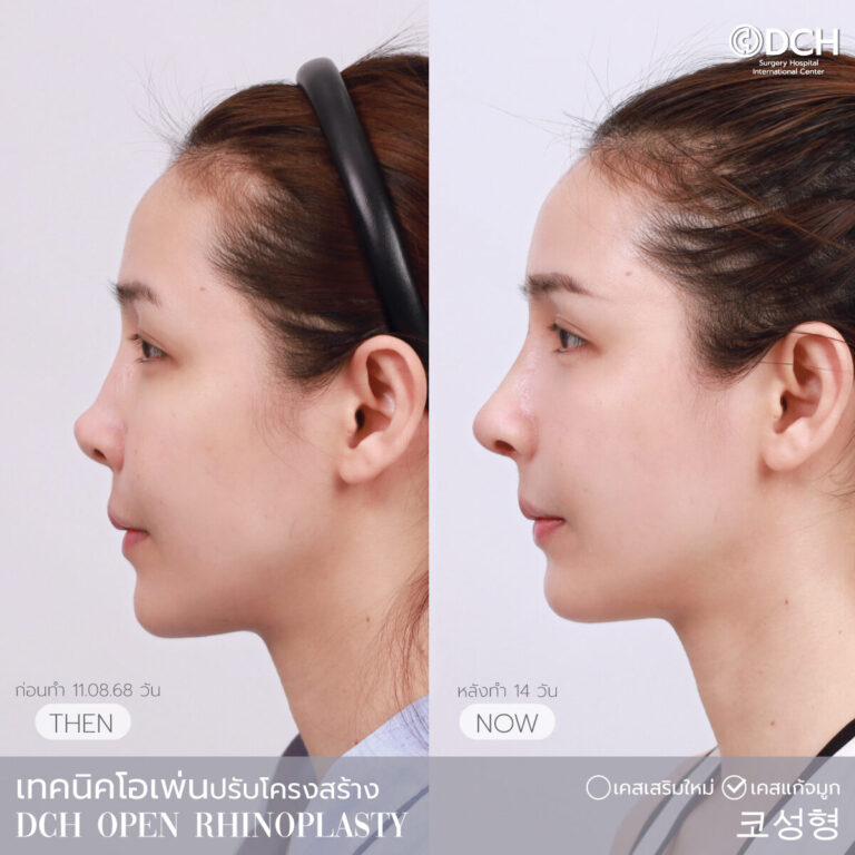 คุณก้อย หลังแก้จมูก