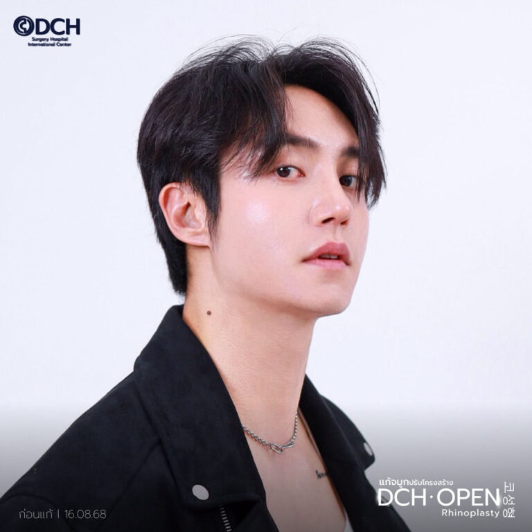 คุณฮิม 14 หลังแก้จมูก