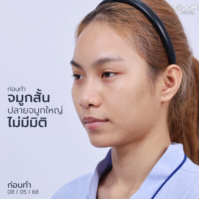 คุณอองออล ก่อนเสริมจมูก